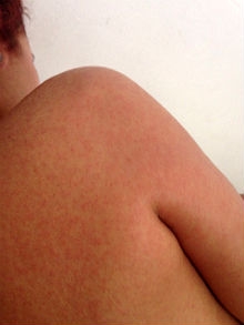 Nova doença apresenta sintomas comuns à dengue, com as manchas no corpo