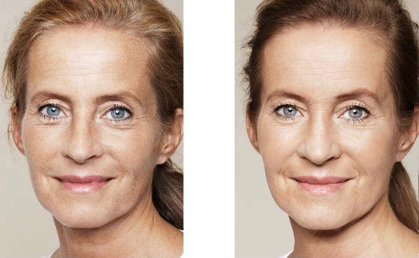 TRATAMENTO Skin Boosters pode ser aplicado no rosto, pescoço, colo e mãos