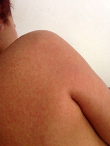 Manchas na pele logo nos primeiros dias da doença fogem do padrão da dengue clássica